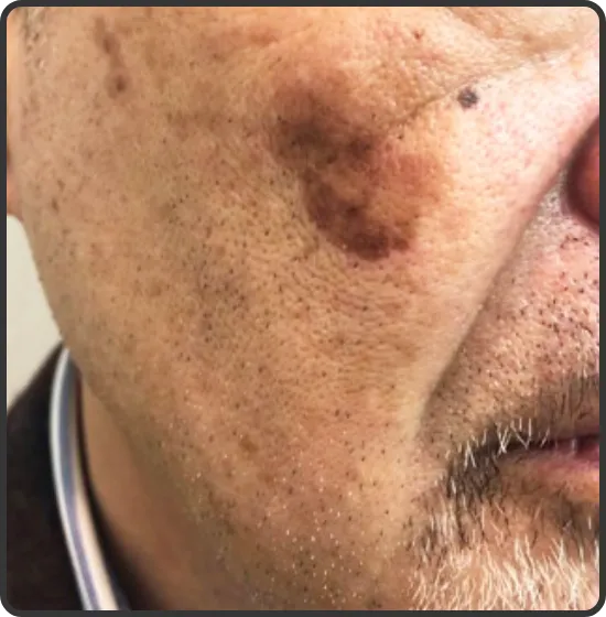 光フェイシャル 照射前 60代