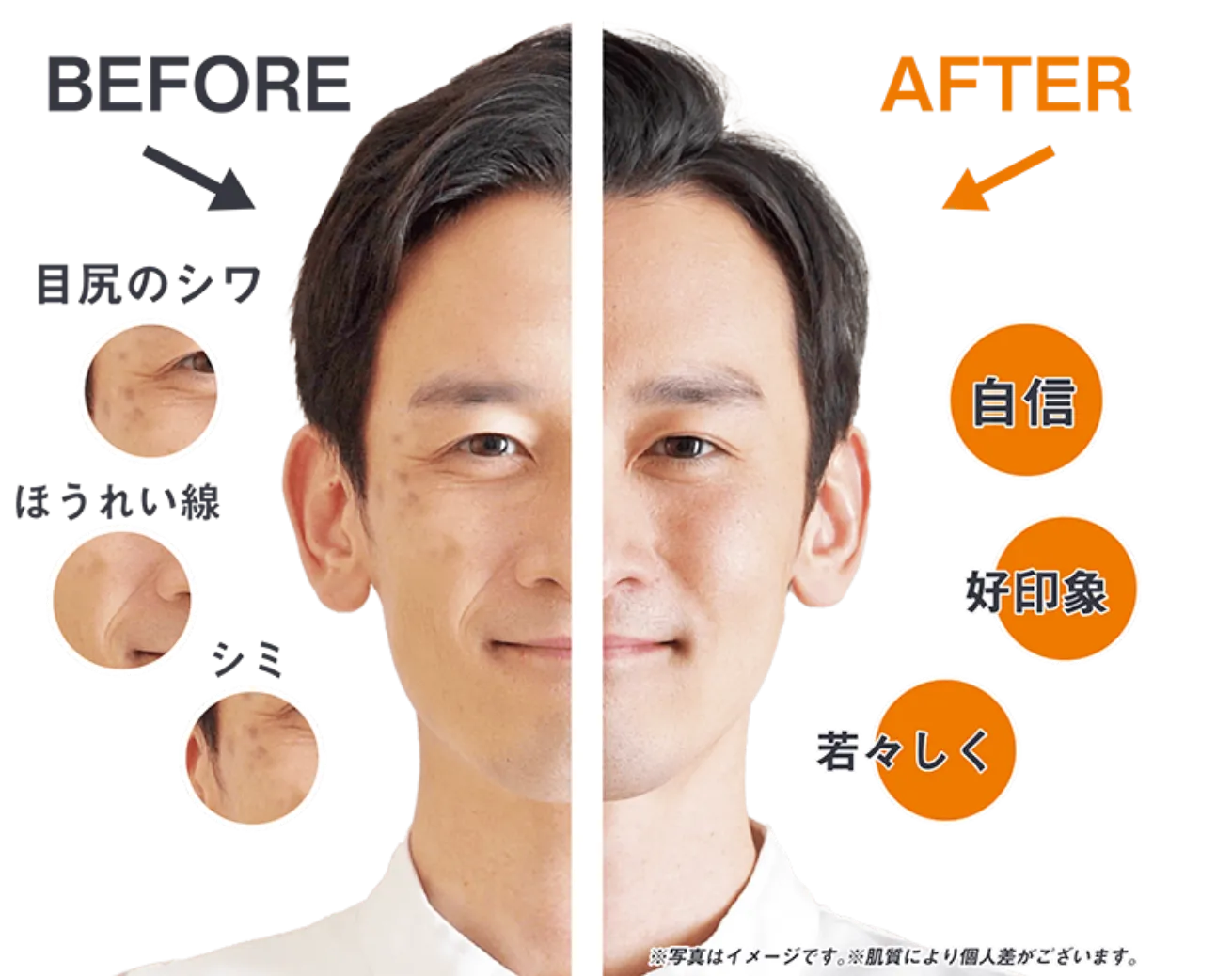 光フェイシャル 目尻 ほうれい線 シミ